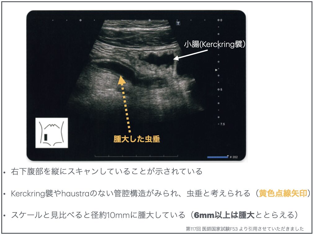 虫垂炎のエコーその2