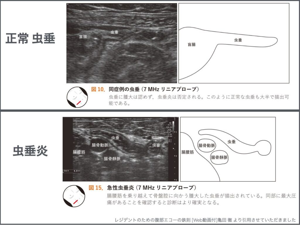 虫垂炎のエコーその1