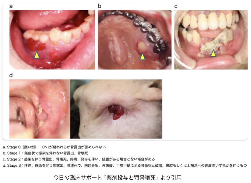 顎骨壊死患者の口腔内と皮膚所見です