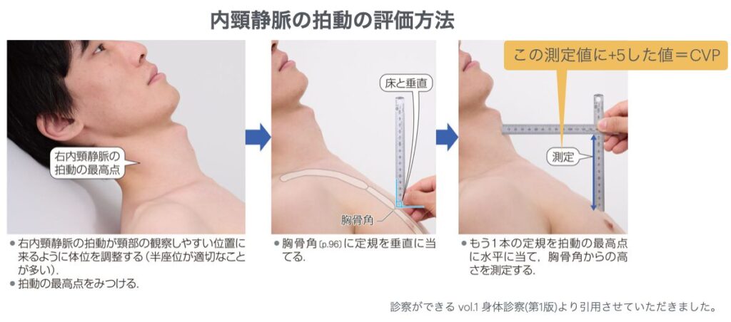 CVPの測定方法