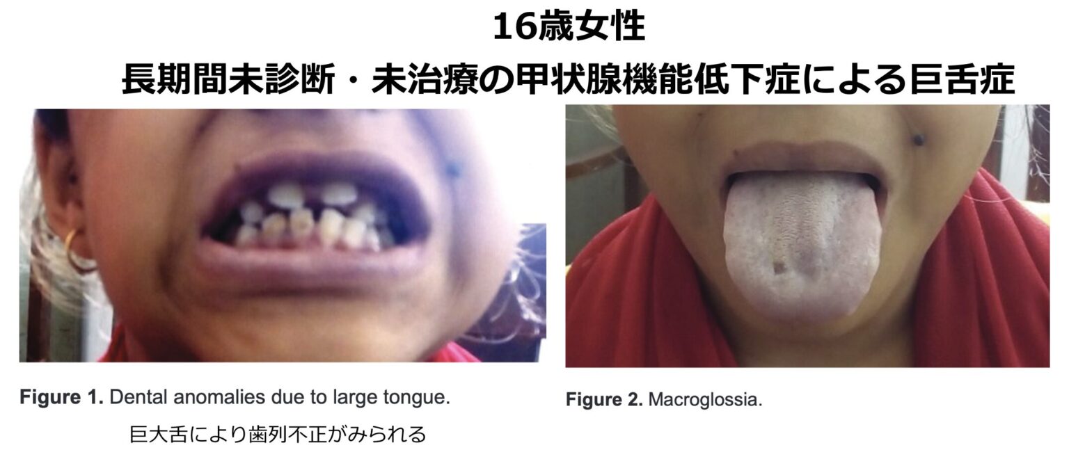 巨舌症の診断と鑑別｜腫瘍や全身性疾患を見逃さない | 医学のすゝめ（医学のすすめ）