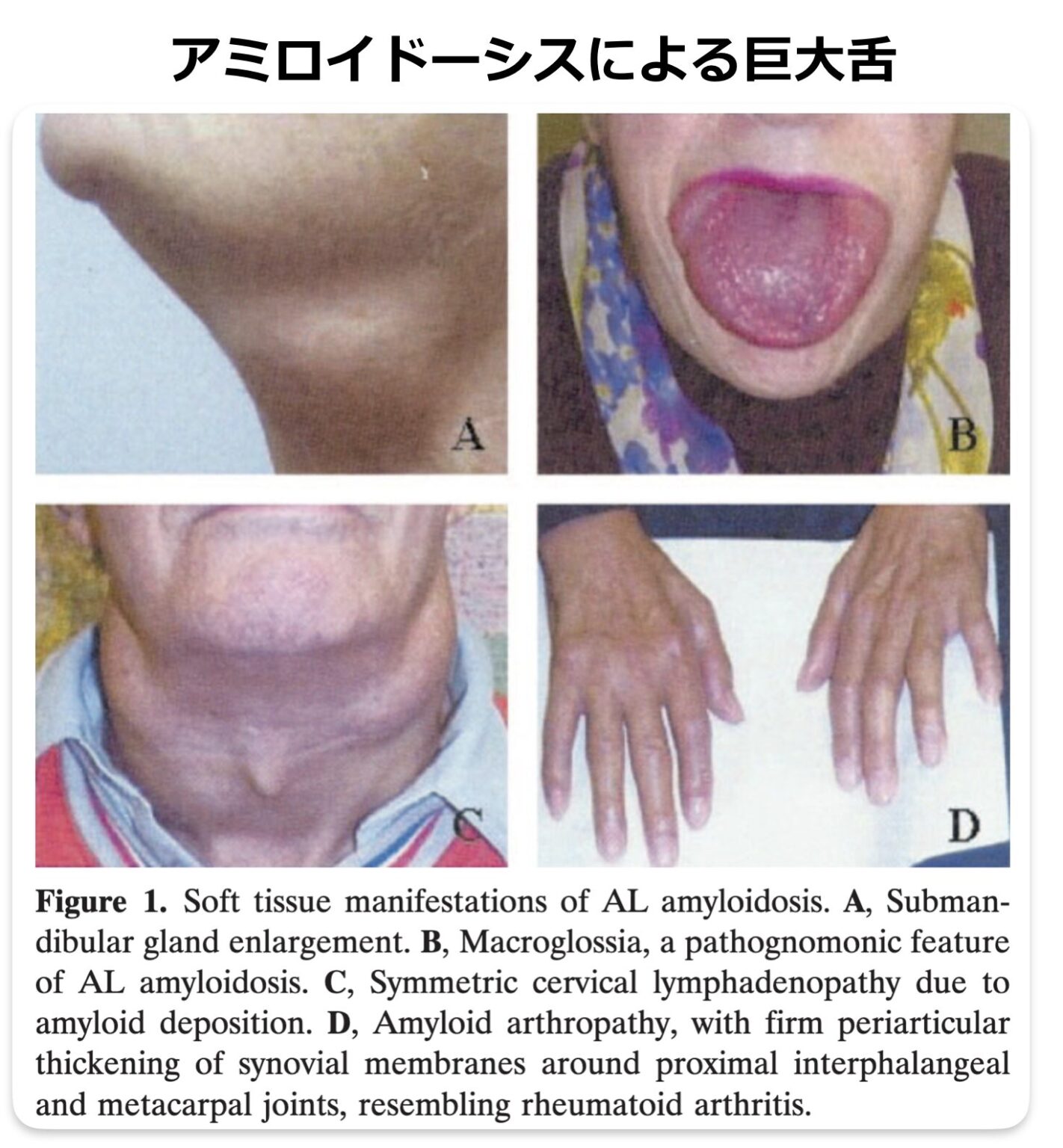 巨舌症の診断と鑑別｜腫瘍や全身性疾患を見逃さない | 医学のすゝめ（医学のすすめ）