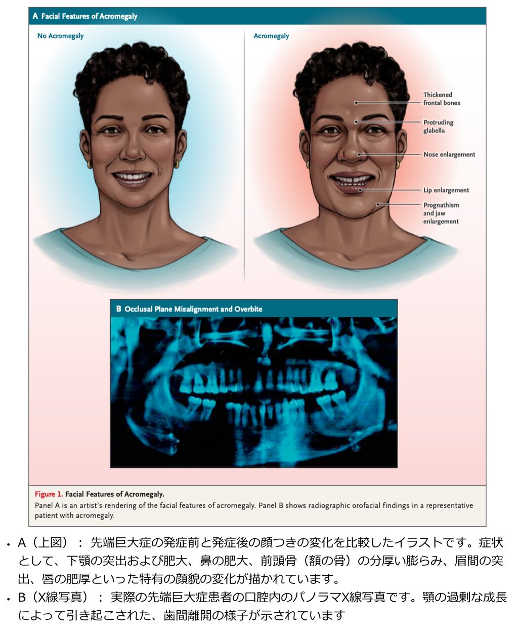 巨舌症の診断と鑑別｜腫瘍や全身性疾患を見逃さない | 医学のすゝめ（医学のすすめ）