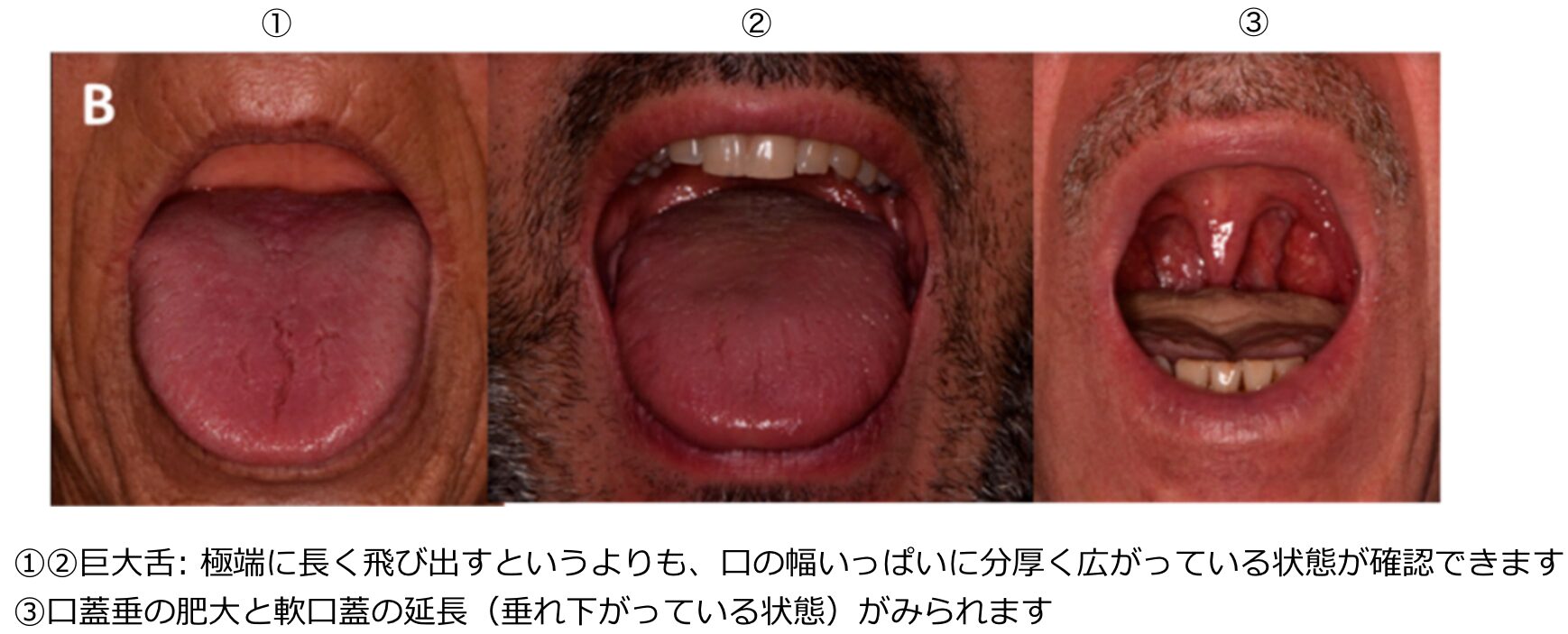 巨舌症の診断と鑑別｜腫瘍や全身性疾患を見逃さない | 医学のすゝめ（医学のすすめ）