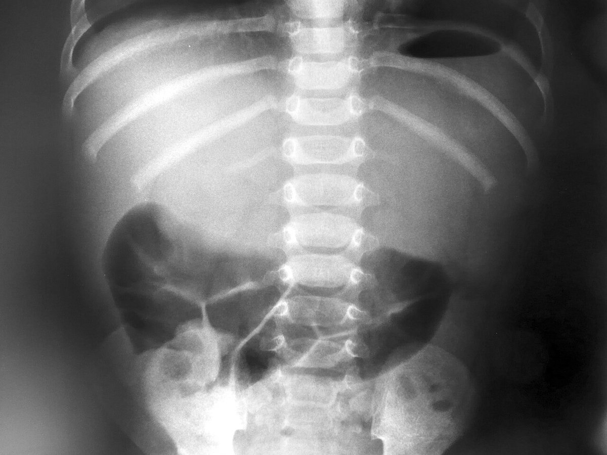 機械的閉塞で拡張した空腸。腸管を完全に横断する細かい輪状ヒダが見える