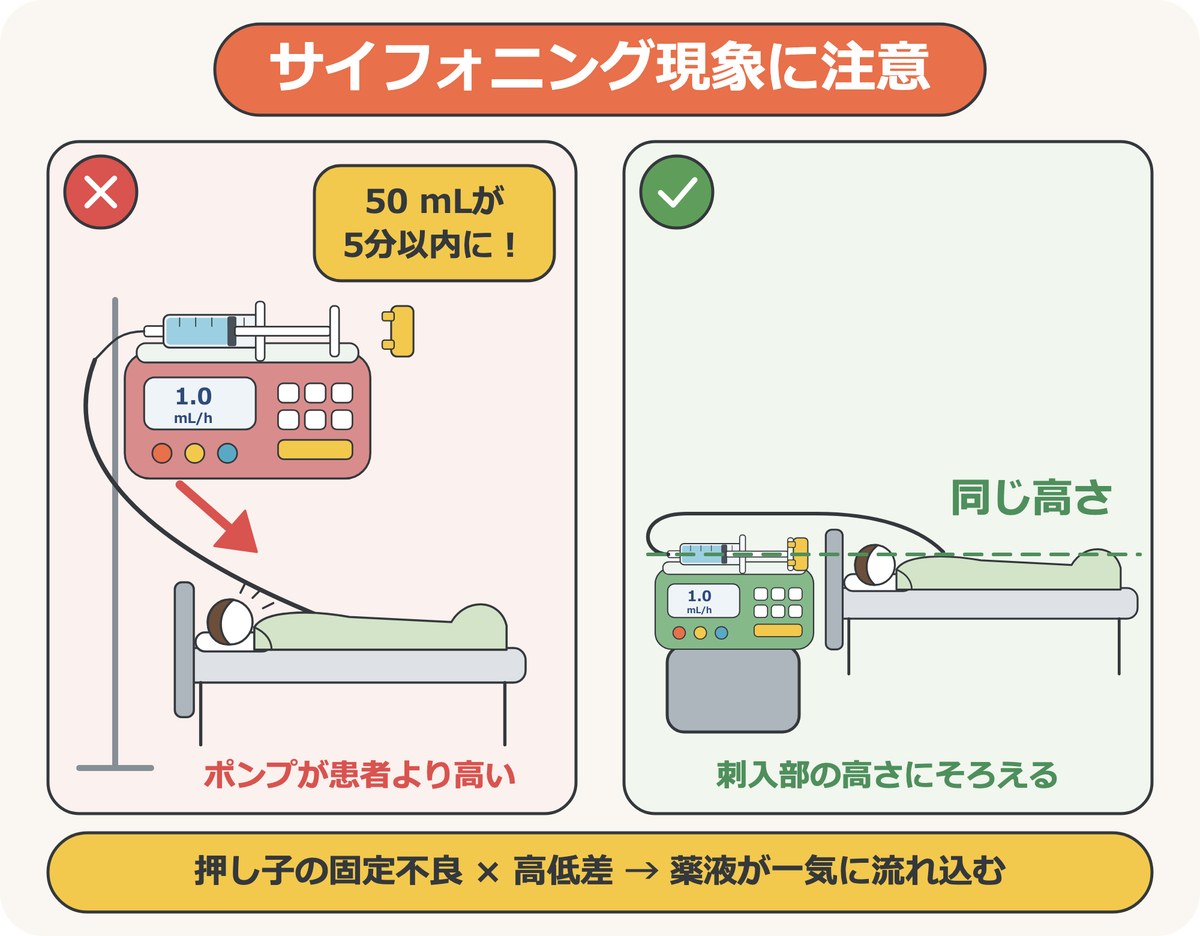 サイフォニング現象。ポンプが患者より高い位置にあり押し子が外れていると、50 mLが5分以内に流れ込むことがある。ポンプは刺入部と同じ高さにそろえる